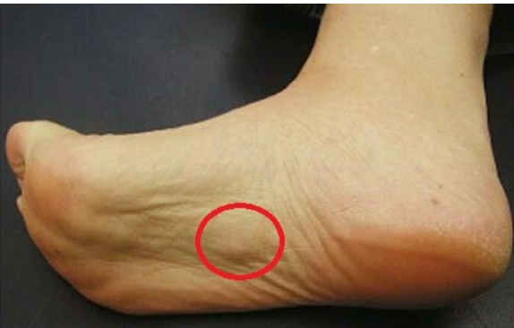 plantar-fibromatosis-jimmy