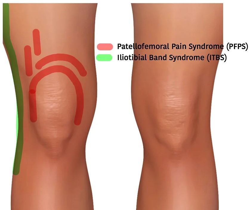 髕股骨疼痛症候群II 物治角度 PatelloFemoral Pain Syndrome PT part JIMMY 醫師部落格